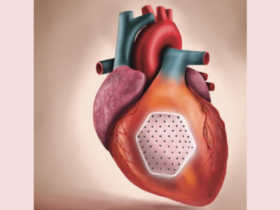 Study results open door to heart failure treatment with ‘heart patch’