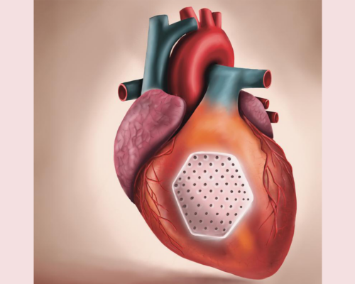 Studienergebnisse öffnen die Tür für Behandlung der Herzschwäche mit „Herzpflaster“