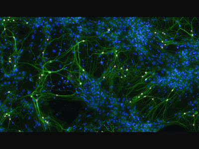 Neue Entwicklungsstörung entdeckt
