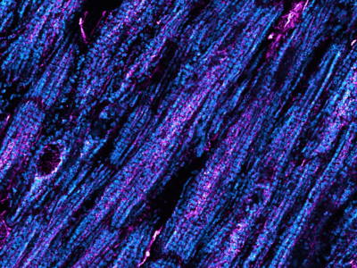 Atrial fibrillation: disrupted calcium communication throws the heart out of rhythm