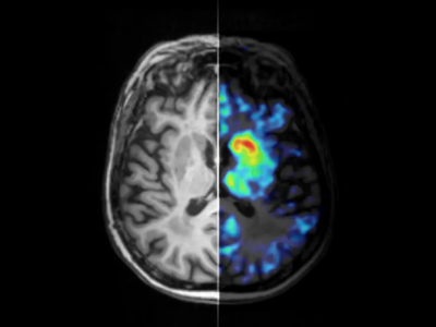 Neue Bildgebungsmethode macht Parkinson-Prozesse erstmals im lebenden Gehirn sichtbar