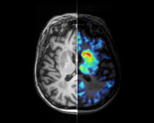 Neue Bildgebungsmethode macht Parkinson-Prozesse erstmals im lebenden Gehirn sichtbar