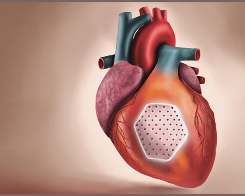 New hope for severe heart failure: heart patch shows clinical efficacy