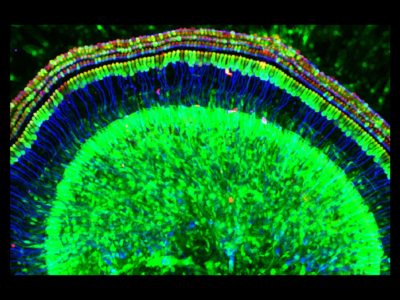 Restoring hearing in people with a rare form of deafness