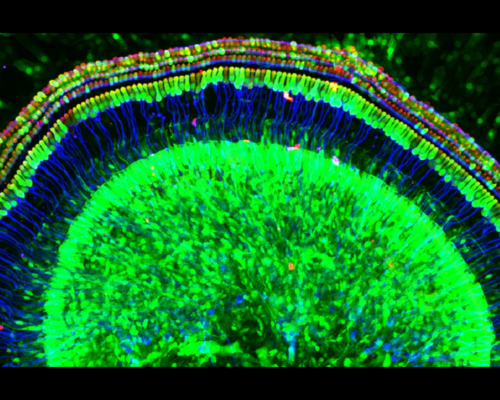 Restoring hearing in people with a rare form of deafness